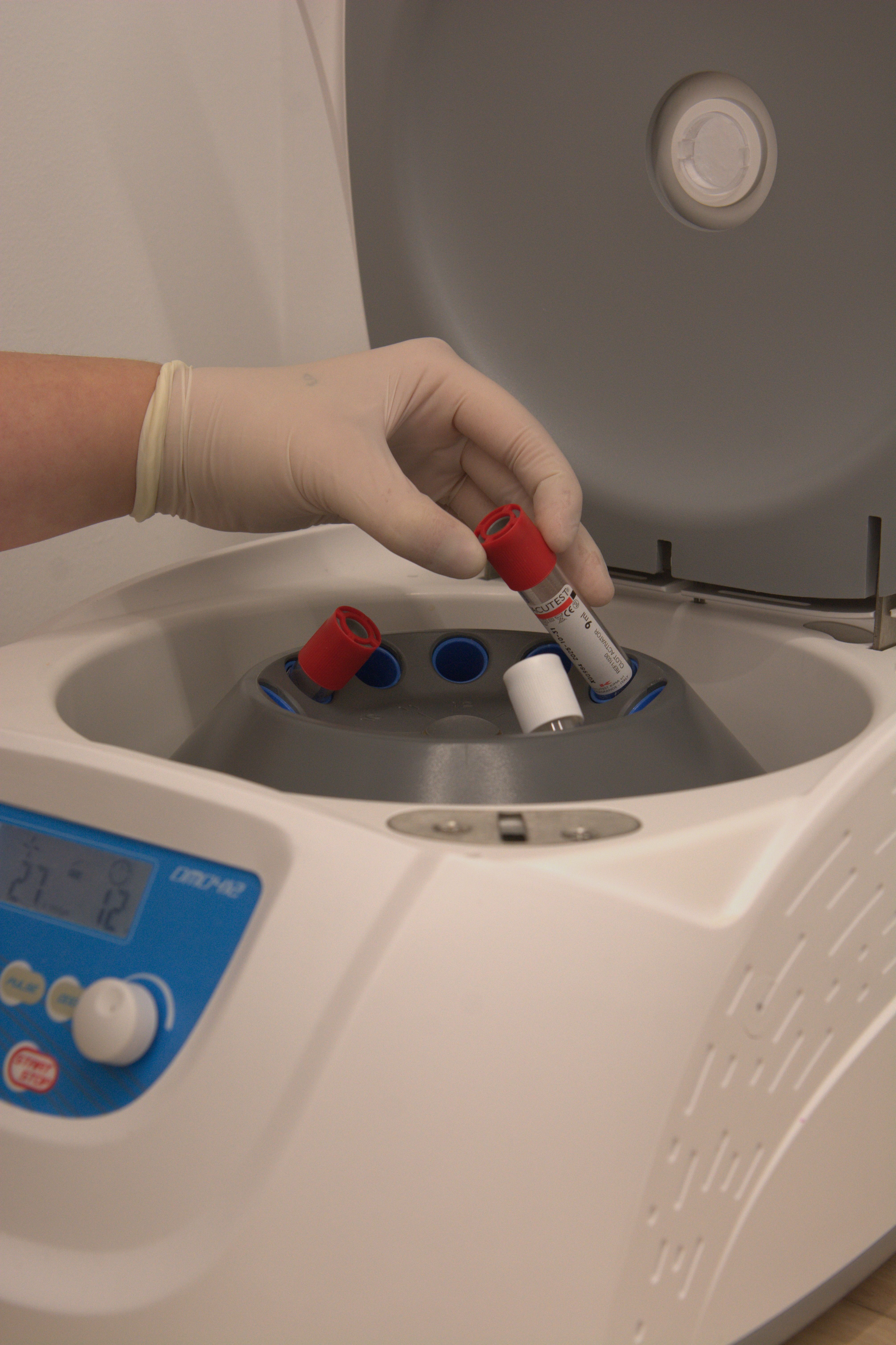 PRF (Fibrina Rica en Plaquetas)